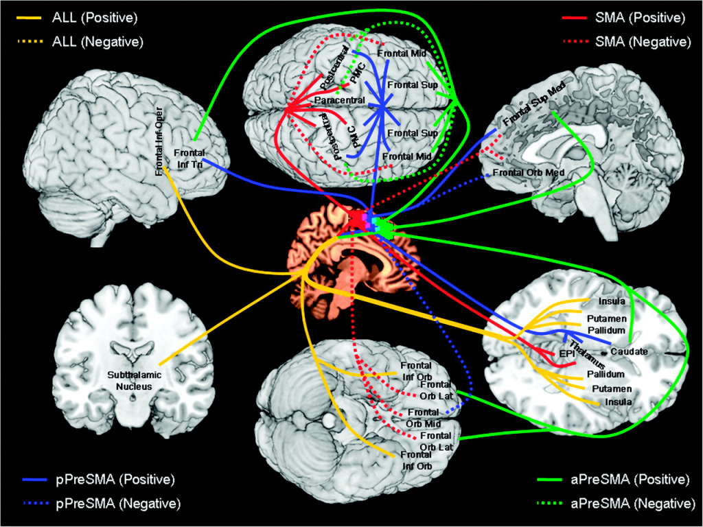 Frontal lobe subcortical